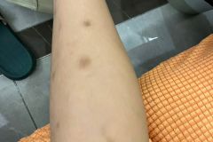 蚊虫叮咬后为什么会留下黑印